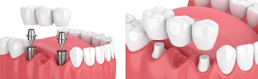 Images of a bridge and an implant-supported bridge