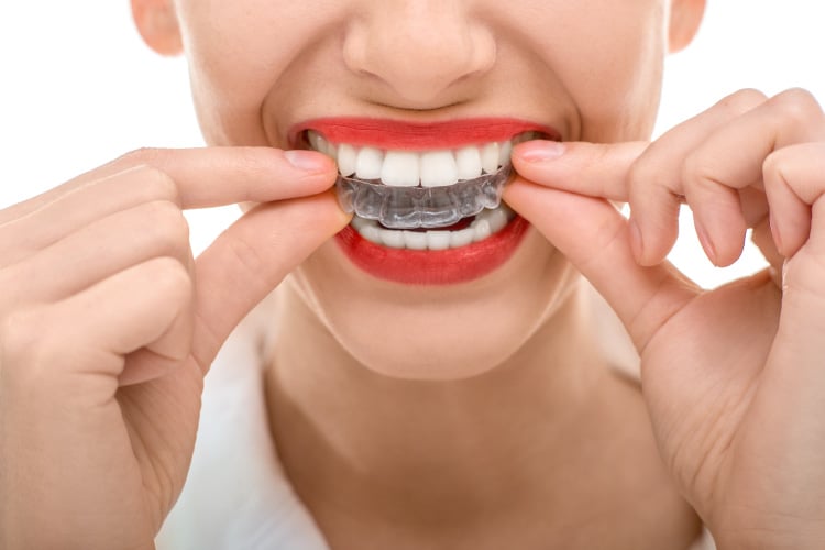 Closeup of a woman with red lipstick putting on her clear aligners