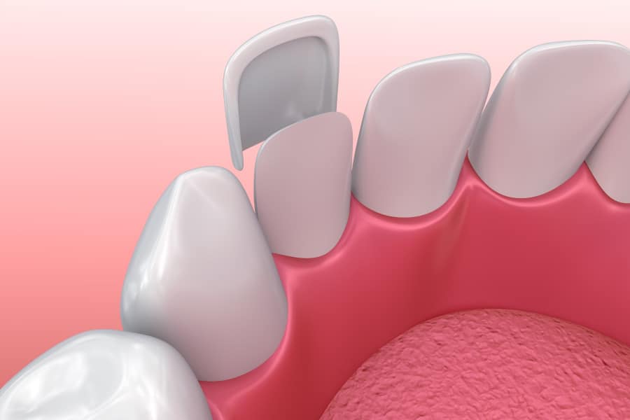 Closeup of a tooth receiving a porcelain veneer in Pearland, TX