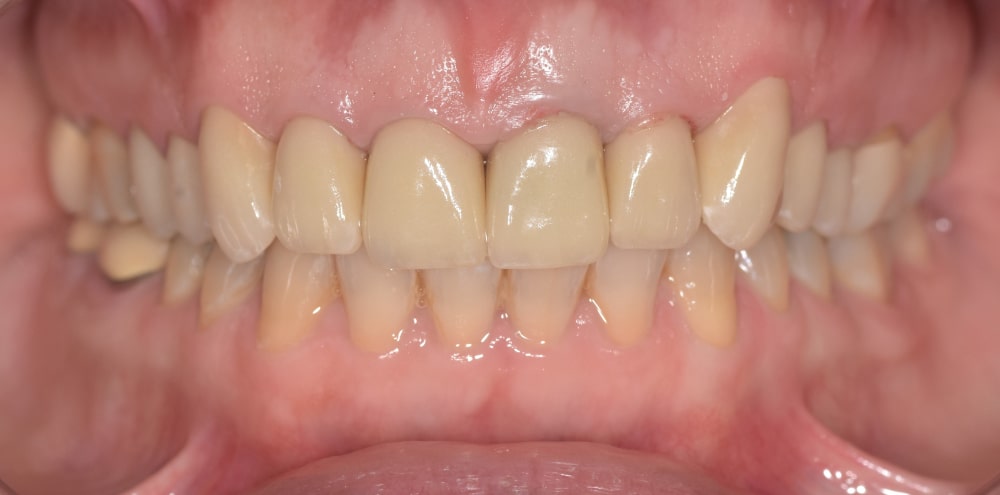 After front crown replacement and gum recontouring