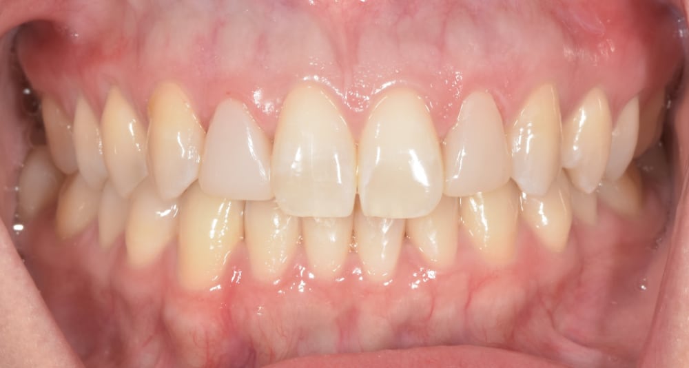 After replacement of front dental bonding