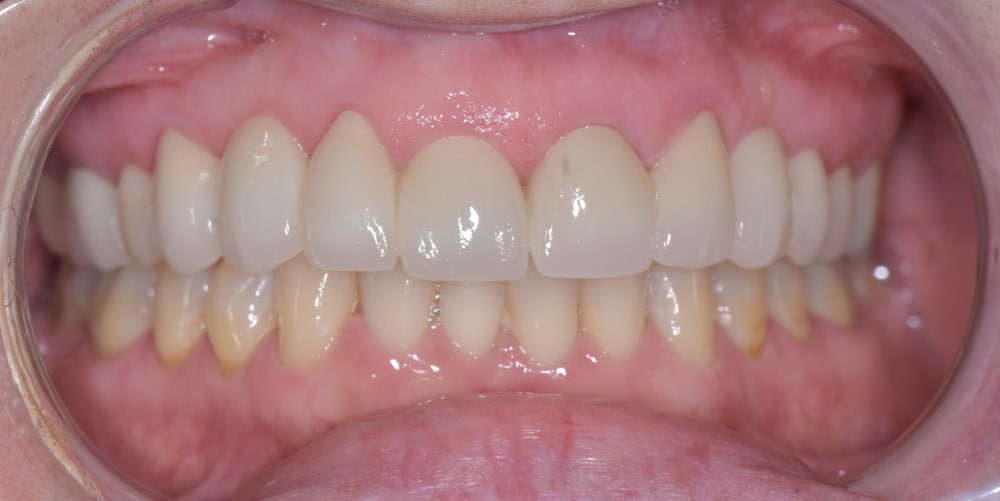 After upper full arch rehabilitation