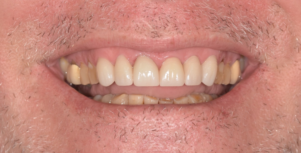 After front crowns and veneers