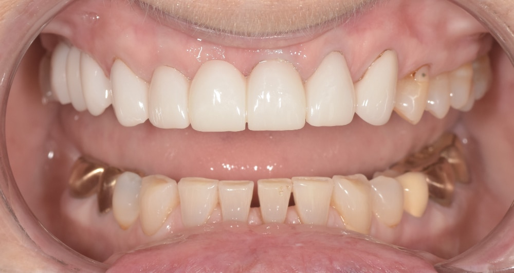 After rehabilitation of aging bridges and crowns