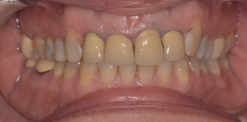 Before front crown replacement and gum recontouring