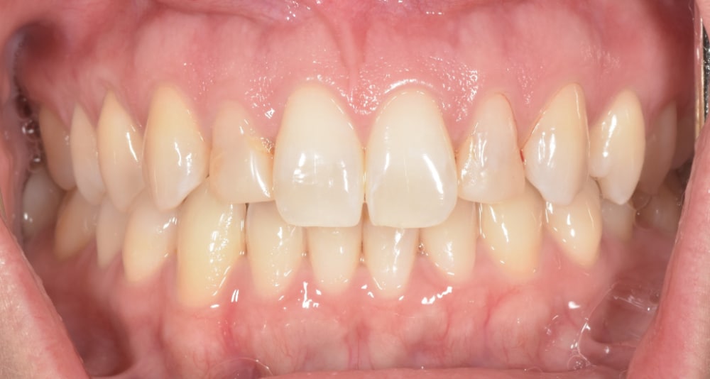 Before replacement of front dental bonding
