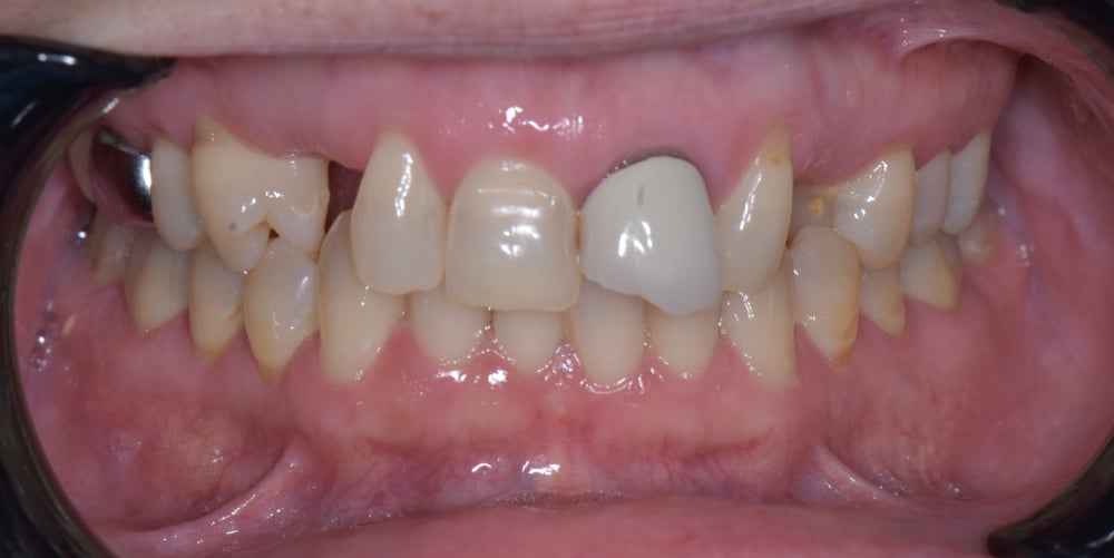 Before upper full arch rehabilitation