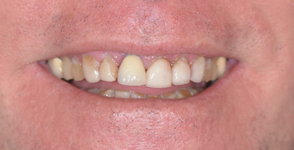 Before front crowns and veneers