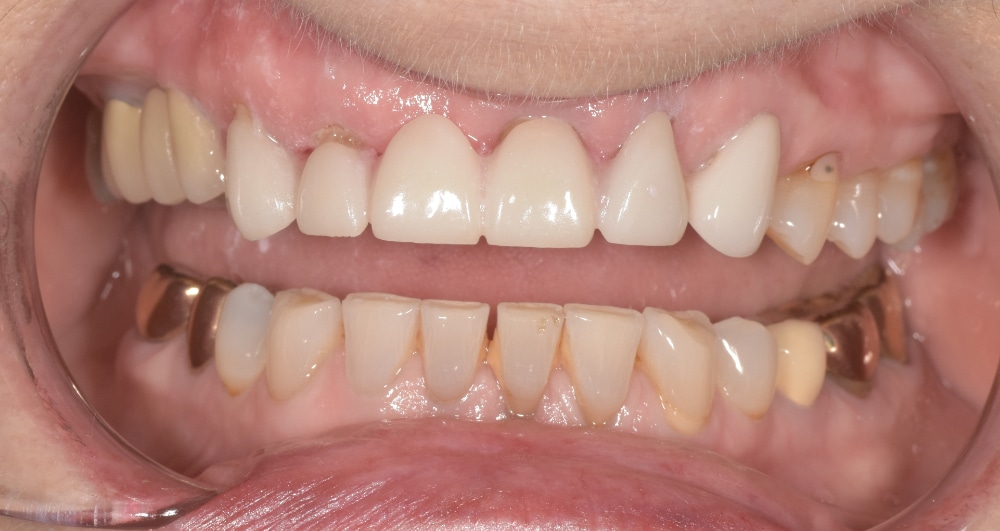 Before rehabilitation of aging bridges and crowns