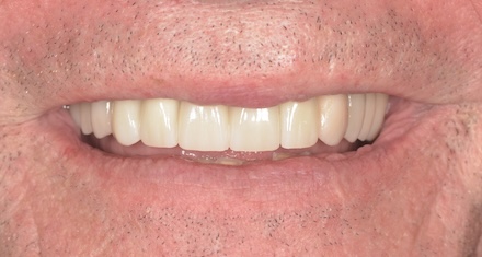 After dental implant treatment