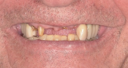 Before dental implant treatment