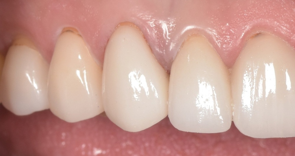 After porcelain veneer replacement