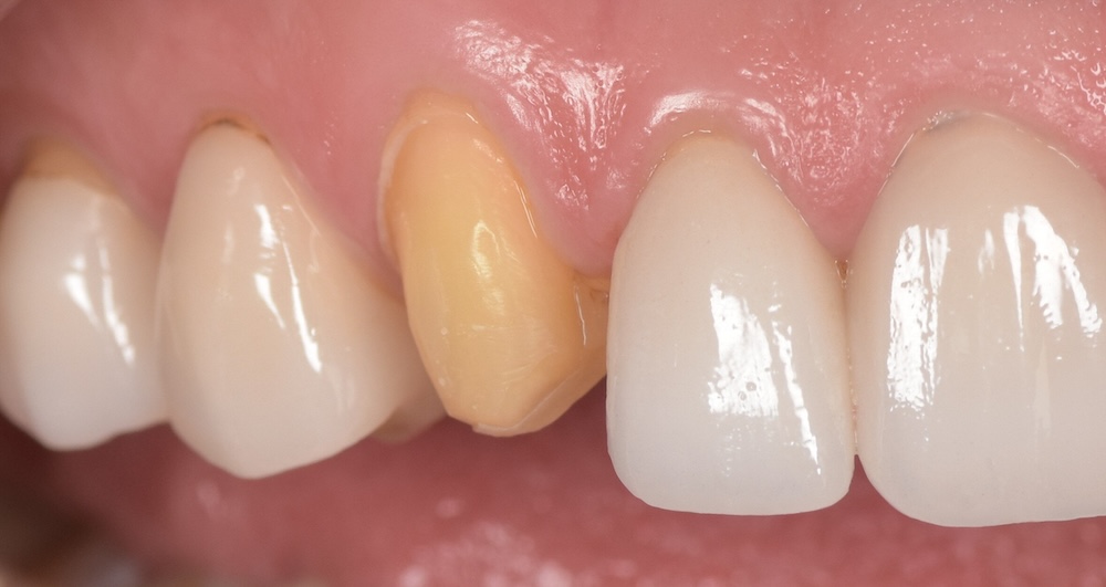 Before porcelain veneer replacement