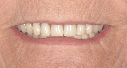 After implant supported dentures