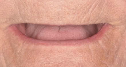 Before implant supported dentures