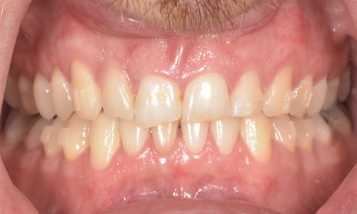 Before chairside composite veneers