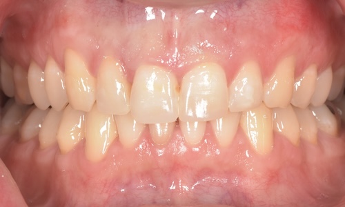 After chairside composite veneers