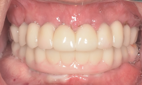 After implant placement and fixed bridges
