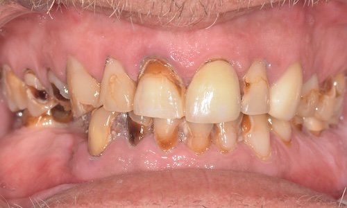 Before implant placement and fixed bridges