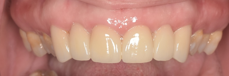 After porcelain bridges and gum therapy