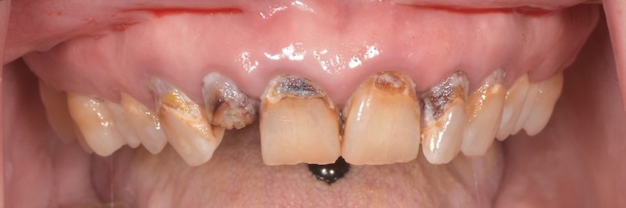 Before porcelain bridges and gum therapy