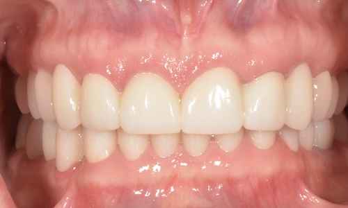 After full mouth rehabilitation