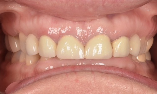 Before full mouth rehabilitation